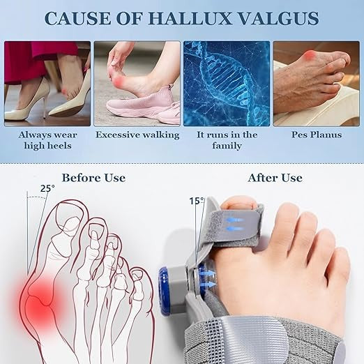 FeetifFix - Bunion Corrector